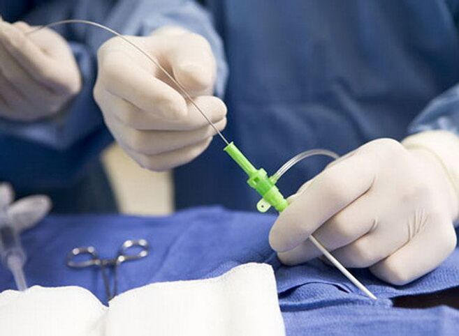 Radiofrekvenčna ablacija